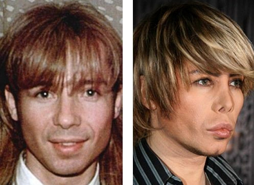 Сергей Зверев до и после операции